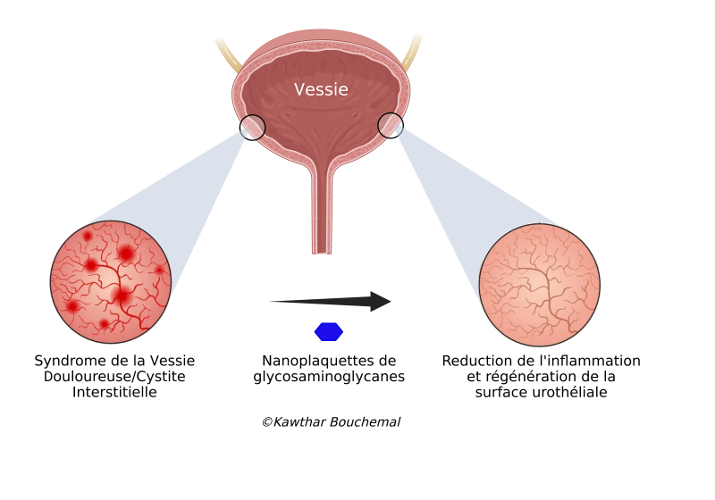La géométrie particulière de nanoparticules de glycosaminoglycanes de forme aplatie et hexagonale s'avèrent très efficaces pour reconstruire la barrière protectrice des cellules de la muqueuse des voies urinaires et combattre ses inflammations